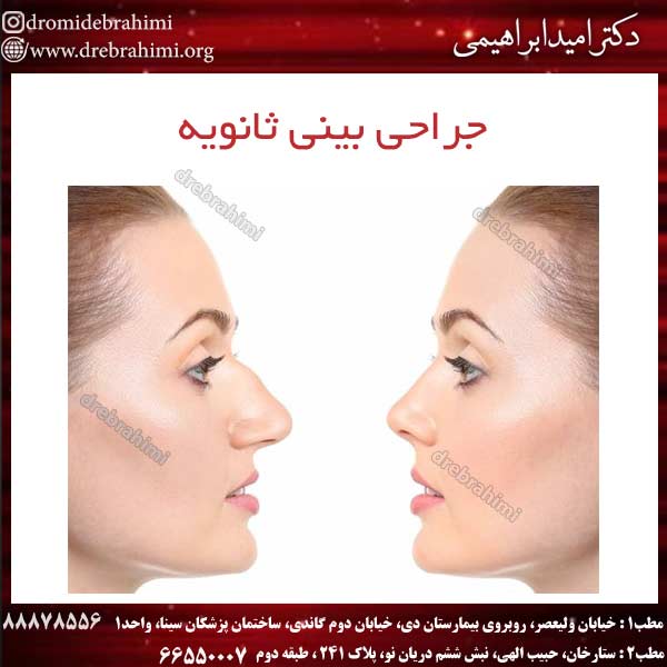 جراحی بینی ثانویه
