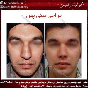 جراحی بینی پهن 