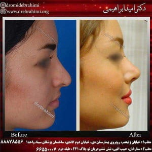 ورزش بعد از جراحی بینی 