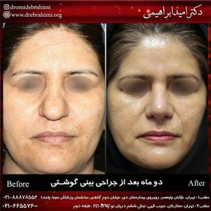 جراحی زیبایی بینی گوشتی
