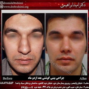 جراحی زیبایی بینی گوشتی