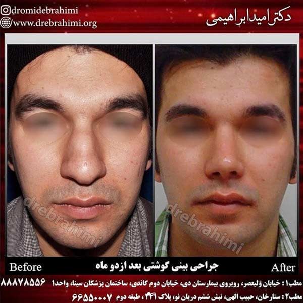 جراحی زیبایی بینی گوشتی