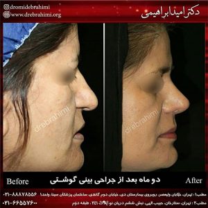 جراحی زیبایی بینی گوشتی