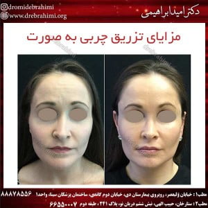 مزایای تزریق چربی به صورت