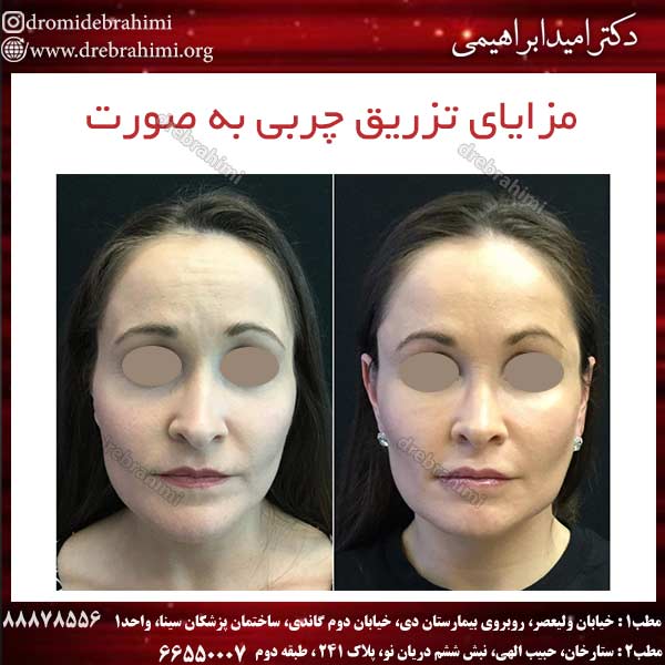 مزایای تزریق چربی به صورت