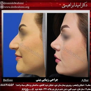 جراحی بینی استخوانی