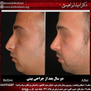 جراحی بینی تهران 