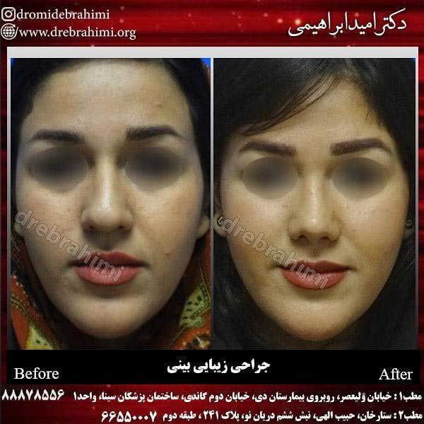 عمل بینی در زنان