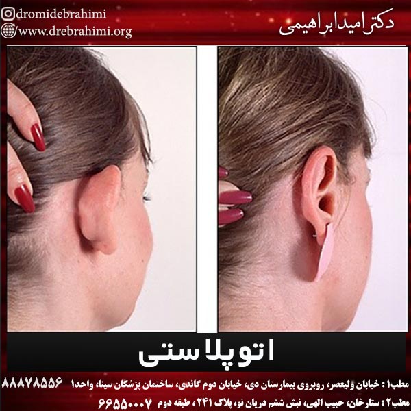 اتوپلاستی