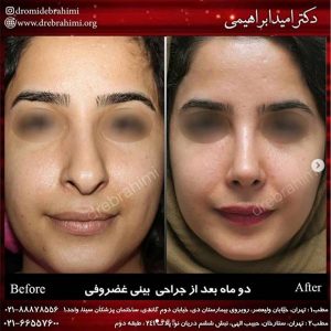 جراحی بینی گوشتی