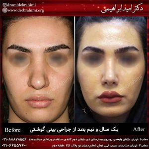 رینوپلاستی