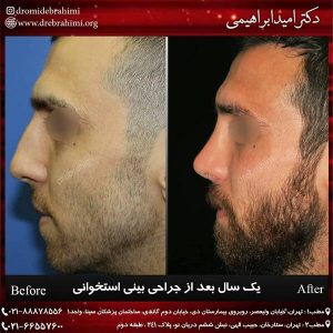 جراحی بینی طبیعی