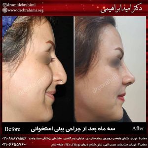 جراحی بینی طبیعی