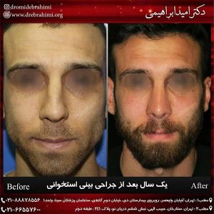 جراحی بینی طبیعی