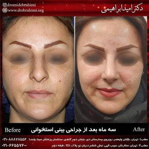 جراحی بینی طبیعی