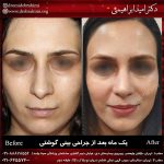 جراحی بینی طبیعی