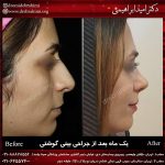 جراحی بینی طبیعی