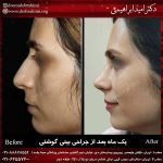 جراحی بینی طبیعی
