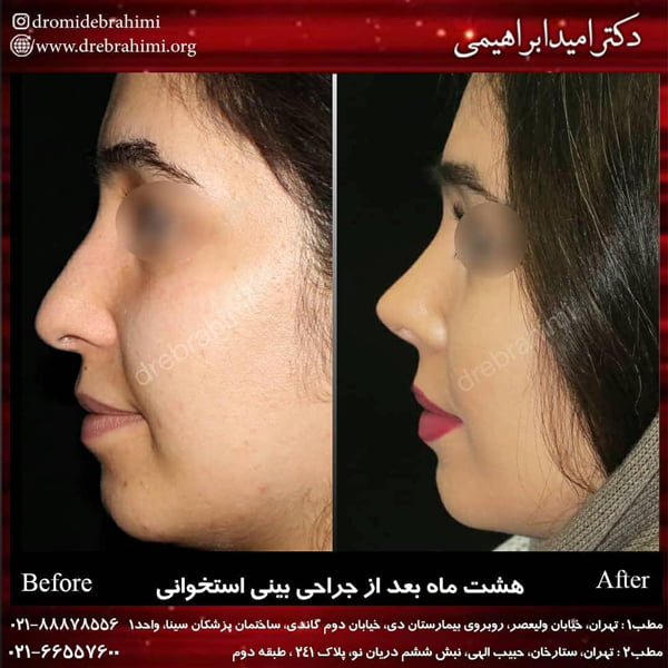 جراحی بینی فانتزی