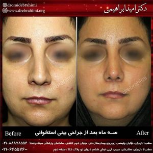 همه چیز درباره جراحی بینی