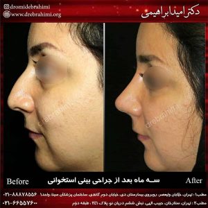 همه چیز درباره جراحی بینی