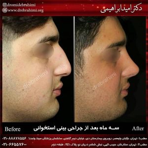 همه چیز درباره جراحی بینی