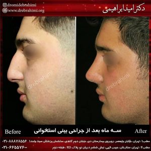 همه چیز درباره جراحی بینی