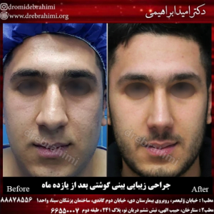 جراحی بینی گوشتی توسط دکتر امید ابراهیمی
