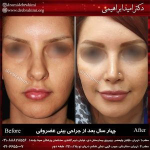 جراحی پلاستیک بینی طبیعب توسط دکتر امید ابراهیمی