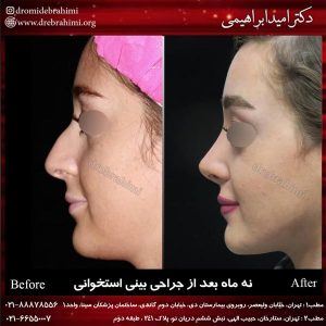 جراحی پلاستیک بینی توسط دکتر امید ابراهیمی
