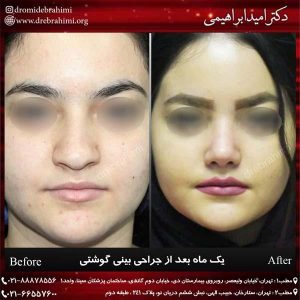 جراحی پلاستیک بینی گوشتی توسط دکتر امید ابراهیمی