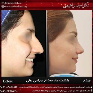 جراحی پلاستیک بینی توسط دکتر امید ابراهیمی