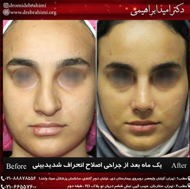جراحی انحراف بینی توسط دکتر امید ابراهیمی بهترین جراح بینی در تهران