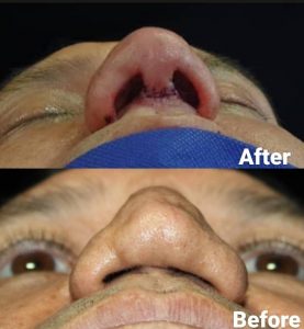 جراحی بینی ترمیمی