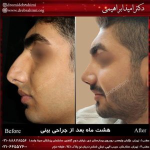 عمل بینی طبیعی مردانه توسط دکتر امید ابراهیمی