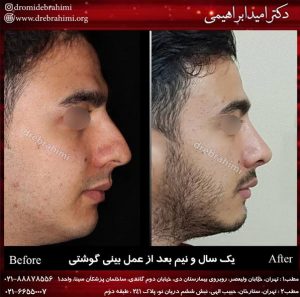 جراحی بینی طبیعی مردانه توسط دکتر امید ابراهیمی