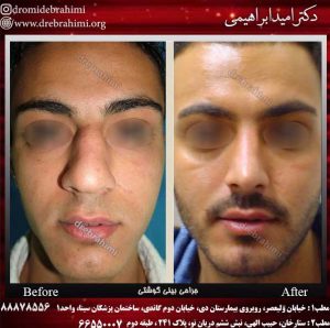 جراحی بینی طبیعی مردانه 