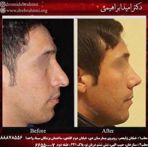 جراحی طبیعی بینی مردانه