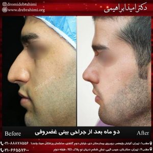 جراحی طبیعی بینی مردانه توسط بهترین جراح طبیعی کار در ایران دکتر امید ابراهیمی