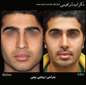 جراحی طبیعی بینی مردانه توسط دکتر امید ابراهیمی