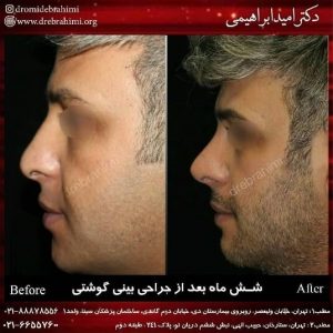 جراحی نوک بینی توسط دکتر امید ابراهیمی