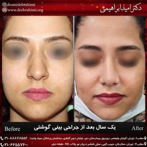 جراحی بینی طبیعی زنانه توسط دکتر امید ابراهیمی
