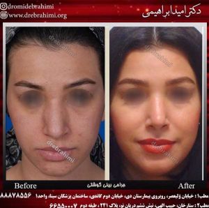 جراحی بینی طبیعی زنانه