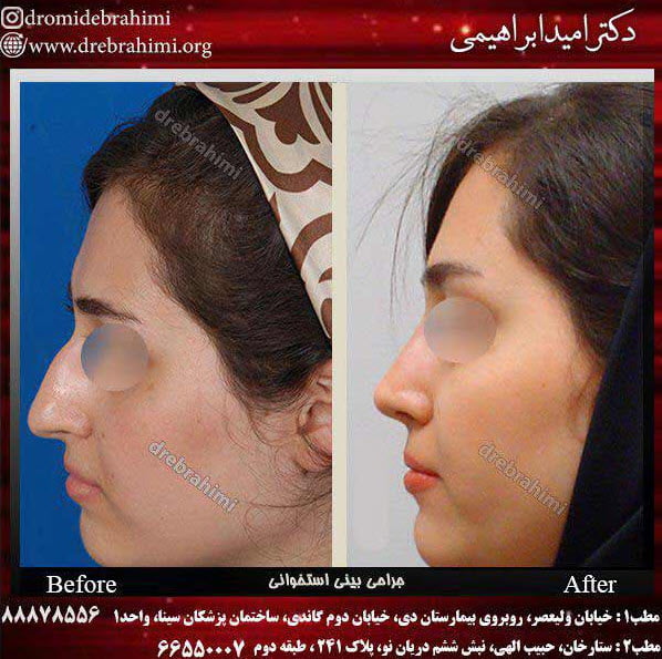 جراحی بینی طبیعی زنانه توسط دکتر امید ابراهیمی