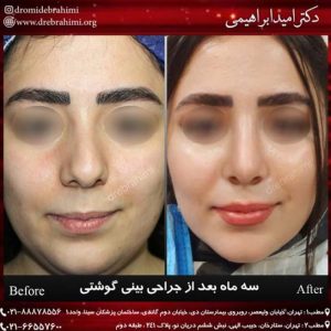 عمل بینی گوشتی زنانه