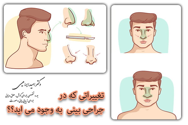 جراحی بینی