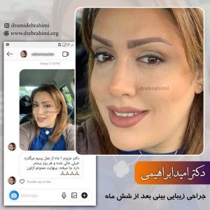 جراحی بینی طبیعی در تهران - دکتر ابراهیمی