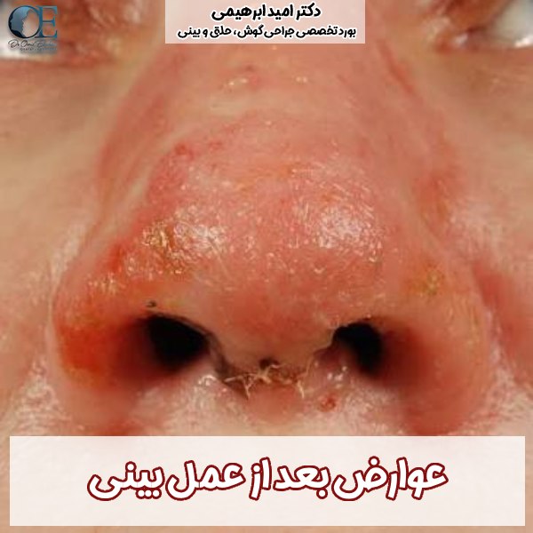 رایجترین عوارض عمل بینی + پیشگیری از عوارض بعد جراحی بینی