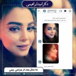 عمل بینی در تهران - دکتر ابراهیمی