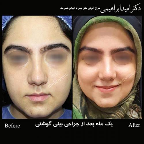 عکس قبل و بعد جراحی بینی گوشتی در تهران - دکتر ابراهیمی